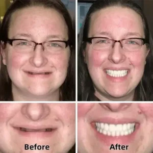 ROSOPL™-Advanced Custom-Fit Functional Dentures