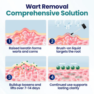 ROSOPL® WartLift Wart Removal Fluid