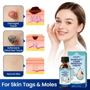 ROSOPL® WartLift Wart Removal Fluid